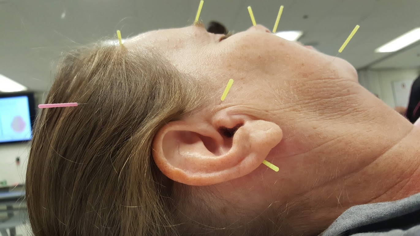 Placement of the Needles