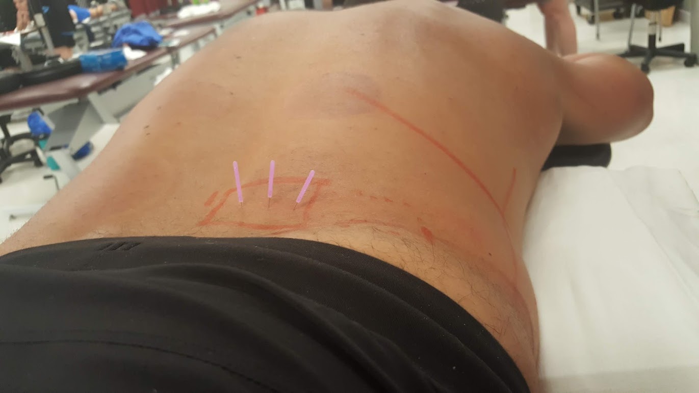 Placement of the Needles